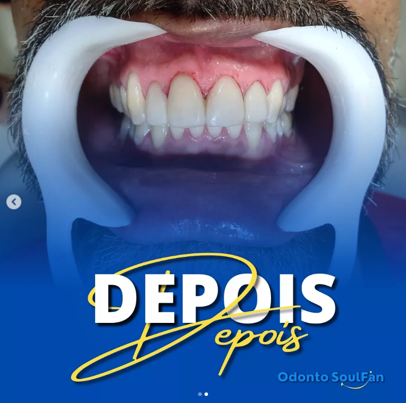 Facetas de Resina